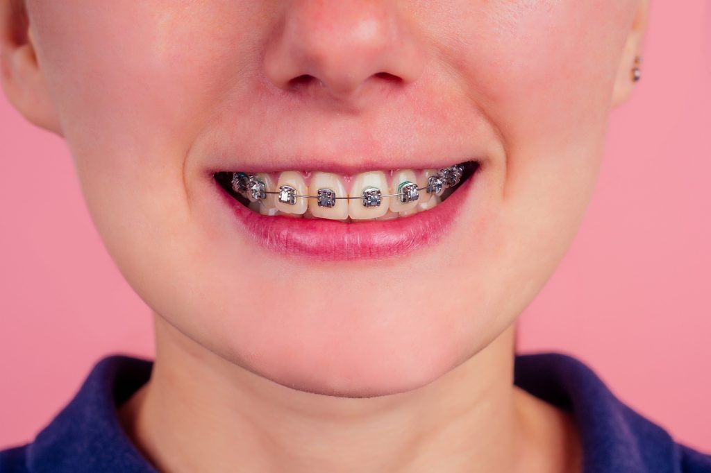 macro shot of white teeth with braces with green color spot